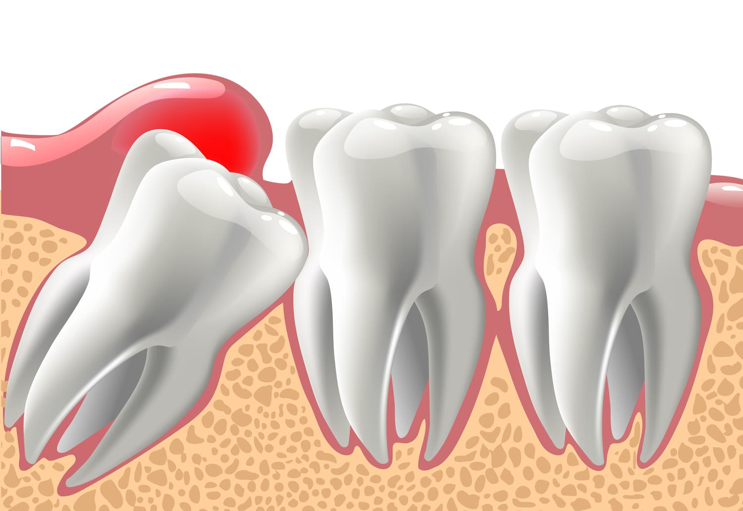impacted-wisdom-tooth