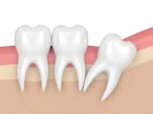 Wisdom tooth removal using Advanced Platelet Technology