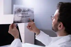 Dental X-ray showing impacted wisdom teeth position for removal evaluation