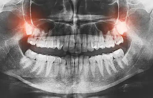 Close-up of wisdom tooth position and impaction in jaw