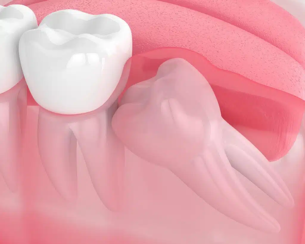 3d render of wisdom tooth impaction