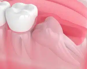 3d render of wisdom tooth impaction