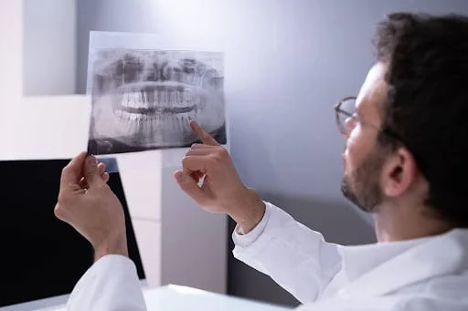 Dental X-ray showing impacted wisdom teeth position for removal evaluation